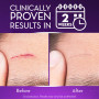 Cicatricure cicatrice Gel crème réduit visible cicatrices à partir de chirurgie, brûlures, acné, blessures 28,3 gram