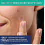 Urgo Patch Hydrocolloide Anti-Boutons + Micro-Needling x9 | Peaux à tendance acnéique avec Collagène Niacinamide Acide hyaluroni